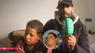 فاس | مادة حارقة تسبب لطفل تشوهات بوجهه و والده يوجه نداءه لذوي القلوب الرحيمة + فيديو مؤثر