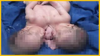 سلا | عائلة توجه نداءاً لإنقاذ توأمين ملتصقين حديثي الولادة في حالة حرجة