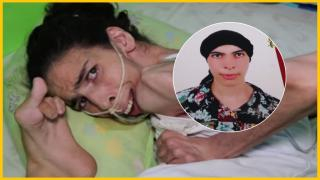 تاونات | مرض غريب ينهش جسد طالبة و يقلب حياتها على عقب