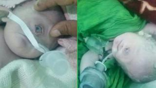 في حالة نادرة الحدوث عالميا | ولادة طفل يمني بعين واحدة وسط البلاد + صور