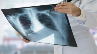 صادم | أزيد من 29 ألف إصابة بداء السل بالمغرب خلال 2020