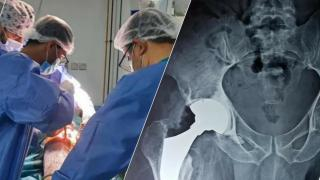 جرسيف | إجراء عملية إستبدال كلي لورك بالمستشفى الإقليمي لفائدة ستيني تعرض لكسر بالفخذ الأيسر + صور