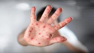 عاجل | المغرب يسجل أول حالة إصابة مؤكدة بفيروس جدري القردة