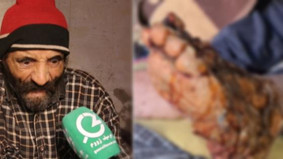 مشاهد مؤلمة… داء السكري يتسبب في تعفن قدم مواطن جرسيفي (فيديو)