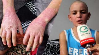 مؤثر | مرض جلدي نادر يفقد طفلا من أحد دواوير الصباب – جرسيف القدرة على التحكم في كفيه و قدميه + فيديو