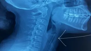 ابتلعت شوكة أثناء لف الحجاب | تدخل جراحي ينقذ سيدة من الاختناق في الدار البيضاء